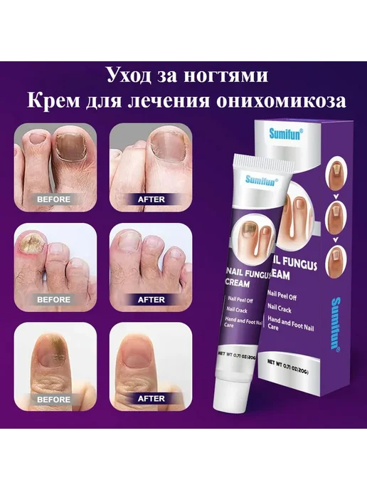 Крем для лечения онихомикоза, 20 г, питает ногти 20 г, 20 г, 20 г