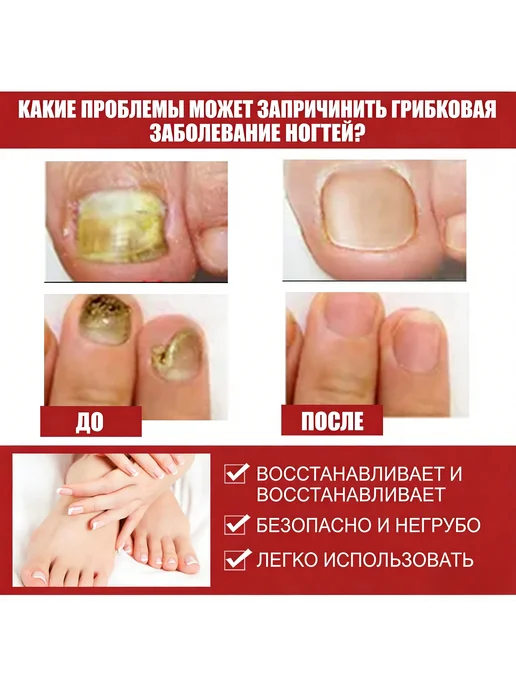 для восстановления ногтевой пластины, 2 шт, фото 2